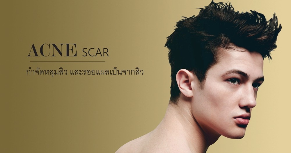 จบปัญหารอยหลุมสิวด้วย Finescan