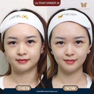 LINE_ALBUM_รวมก่อนหลังทำ อัพเดท_241112_1