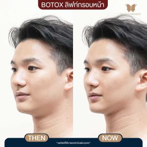 LINE_ALBUM_รวมก่อนหลังทำ อัพเดท_241112_2