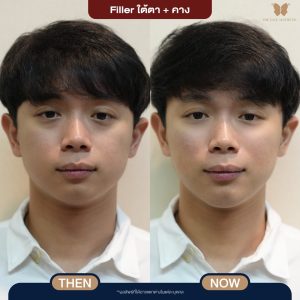 LINE_ALBUM_รวมก่อนหลังทำ อัพเดท_241112_27
